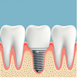 Implant Restoration