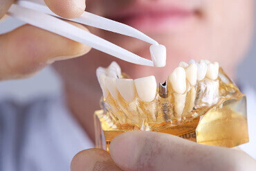 Implant Dentistry