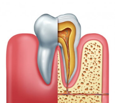 Root Canal