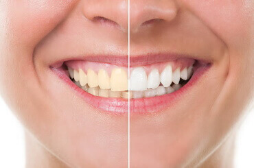 Whitening