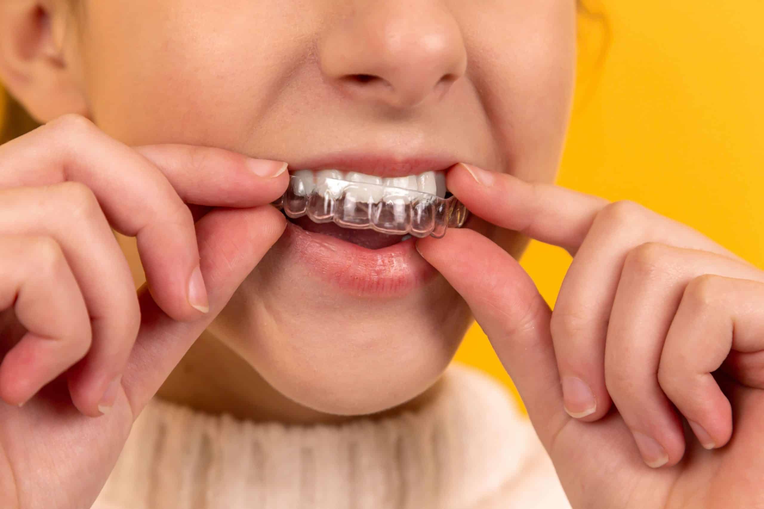 teeth whitening dentist