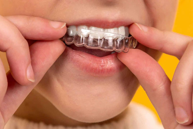 Is Teeth Whitening Permanent?
